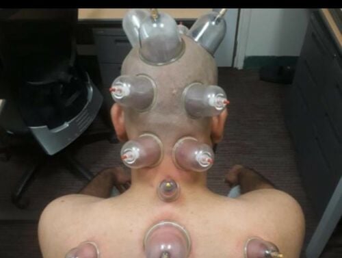 Hijama. (Cupping Therophy)