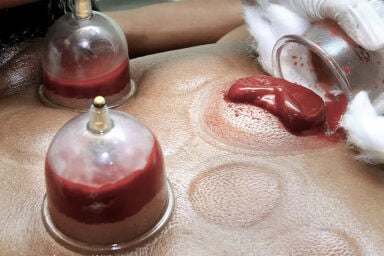 حجامه ( طبيه وعلاجيه ووقائيه )