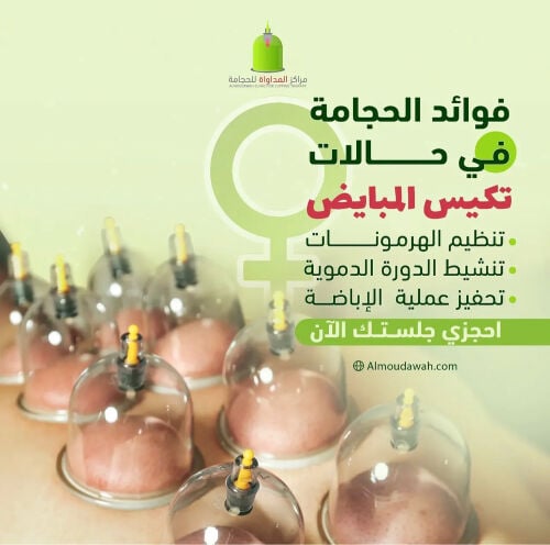 علاج تكيسات المبايض بالحجامه 