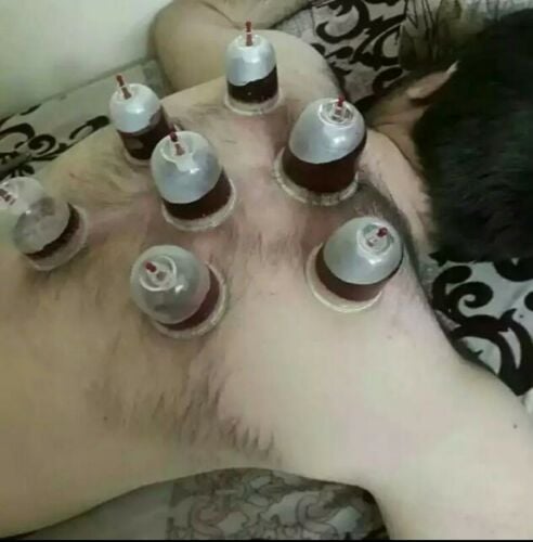 Hijama. (Cupping Therophy)