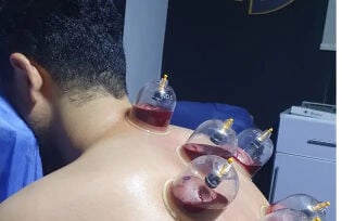 حجامه وقائيه وعلاجيه 