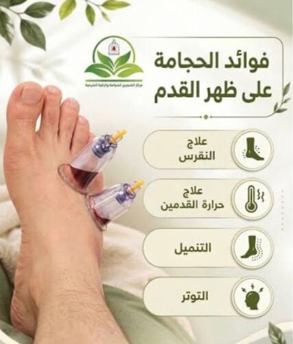 حجامه لتخفيف اعراض النقرص 