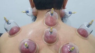 حجامه وقائيه وعلاجيه 