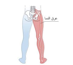 حجامه عرق النسا