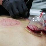 اخصائي حجامه طبيه 