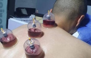 حجامه طبيه علاجيه ووقائه 