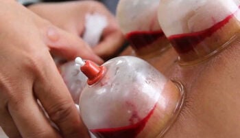 اخصائي حجامه علاجيه 