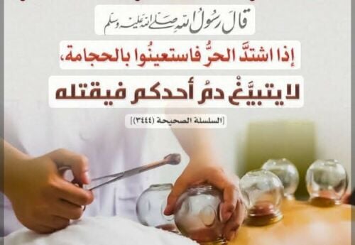 الحجامه في الحر سنه وشفاء
