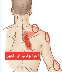 حجامه الابهر ( الوهنه - اللعصبه )