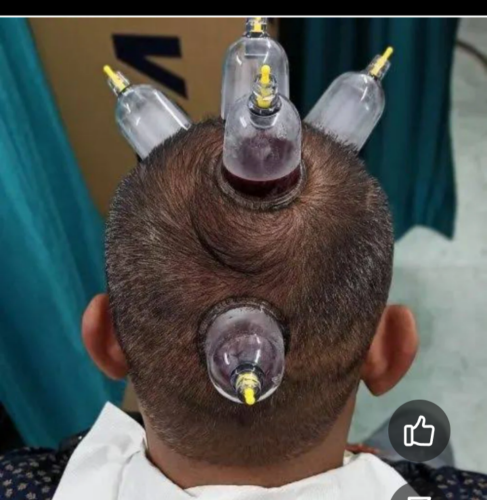 حجامه الرأس بدون حلاقه