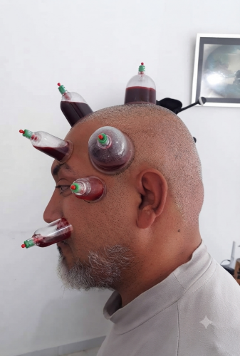 حجامه تنشيط الذاكره وذياده التركي