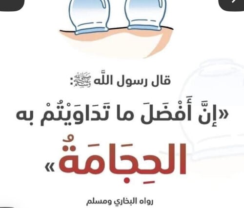 حجامة